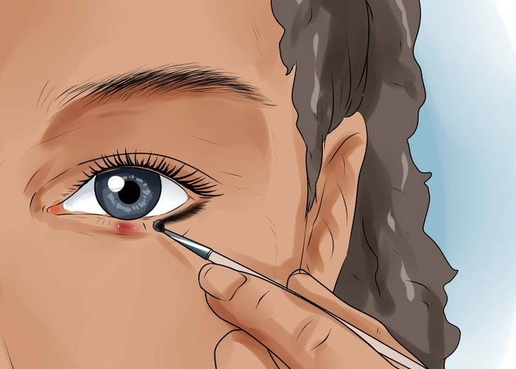 Нүдний өвдгийг гэрийн нөхцөлд хэрхэн эмчлэх вэ