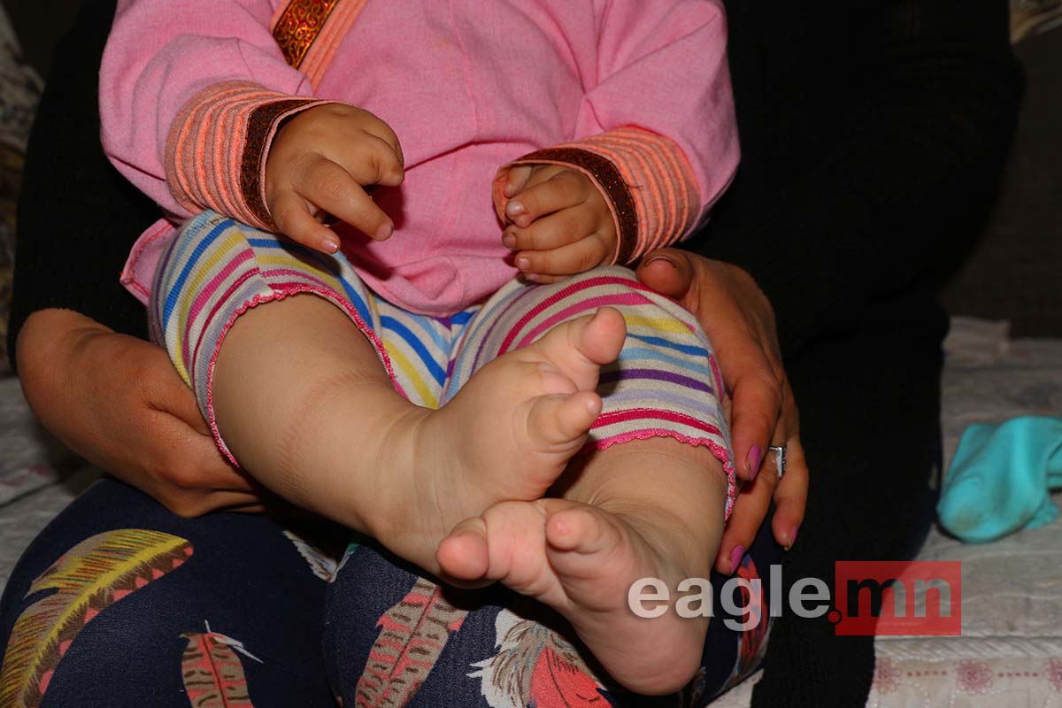 СУРВАЛЖЛАГА: Хоёр хөлөндөө дөрөвхөн хуруутай бяцхан охин Ш.Буянжаргалынд өнжлөө