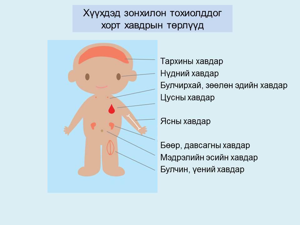 Ихэнх тохиолдолд хүүхдийн хавдар оношлогдохгүй үлддэг